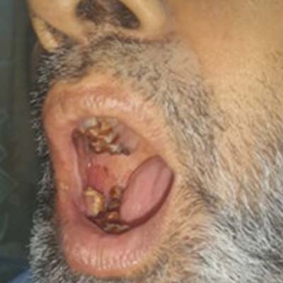 Jaw Cancer 1